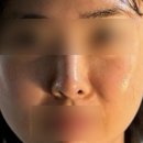 부산 팔자주름 고민녀의 쥬베룩볼륨 솔직 후기