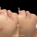 메이비유에스테틱(MayBUaesthetic) | 천안 여드름관리 잘하는 곳 여드름에 진심인 메이비유에스테틱 리얼 후기