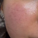 유니온 피부과의원 | 내돈내산 포텐자 3회차 리뷰 feat. 1회차와 비교