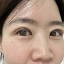 대학종로약국 | [서울/종로] 혜화역 대학로 성형외과 쌍꺼풀 수술 직 후 ~ 일주일, 2주일 후기 수술 후 주의 사항 (40대...