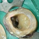 세브란스박치과의원 | 봉천역치과 임산부 어금니 극심한 치통, 막힌 신경관 재신경치료 증례 (임신 35주)