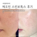 창원피부과 l 제오민스킨보톡스 처음 받아본 후기 (통증·효과·가격 정리)