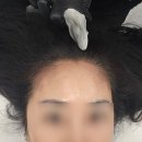 어드반SMP | 안산 두피 반영구 잘하는 곳 힐링 되는 탈모관리 어드반 SMP