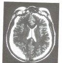 3.만성 경막밑혈종[chronic subdural hematoma] 이미지