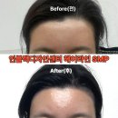 인더라인25시편의점 | 노원 헤어라인 잘하는 곳 노원 두피 SMP 인블랙디자인센터 후기