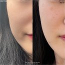 뷰티멍 | 인모드 땅콩형 얼굴 관리 멍 효과 본 솔직 후기 (인모드 FX, Forma 비교)