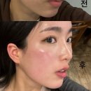 신매근린공원 | 대구수성구 시지피부과 주근깨제거 헐리우드+클라리티 2회차 효과 후기 리쥬엘의원 수성점
