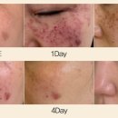 콜드플라즈마 이미지