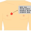 남성 유방암과 여유증의 구별점 이미지