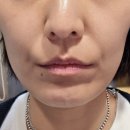 숨어있는 V브이라인을 찾아주는 리프팅주사 ♡ 미랩클리닉 히든브이 주사 1차 시술 후기