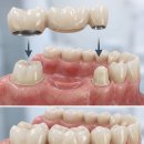 다이아몬드치과의원 | 수원 양심 치과 3unit bridge 치료란?