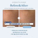 제이뷰티라운지 | 대구 JB뷰티라운지 트라이엄에너지케어 후기｜주근깨가 도드라져 보이던 피부톤 관리