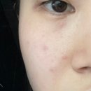 수란트라 크림 5~8주 사용 후기 | 주사 피부염 치료 변화 기록