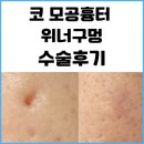 [코 모공흉터] 위너확장구멍 수술 후기 (내돈내산)