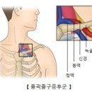 흉곽출구증후군 (Thoracic outlet syndrome) 이미지