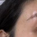 새생명한방병원 | [수원] 인계동 한방피부과 여드름 흉터치료 새살침 2회차 후기 (내돈내산)