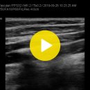 athrosclerosis(carotid sono) 이미지