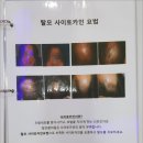 MTS 치료 - 인천탈모병원, 연세모벨르 원형탈모 치료 후기