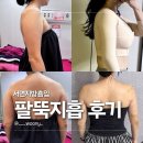 서면지방흡입 팔뚝 수술 당일 ~ 일주 일차 후기 (통증, 멍, 부기)