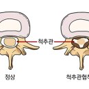 수필라레