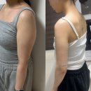 팔뚝지흡후기 3개월차, 부평지방흡입 통증 붓기 싹 다 알려드림