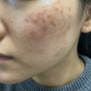 리바이 | (사진후기) 리바이포유 리본크림 트라넥삼산 세럼 기미 해결