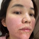 민간약초 생활한방 | 인천여드름자국ㅣ구월동 피부과에서 약초침과 엠톤을 한 번에 듀얼테라피 후기