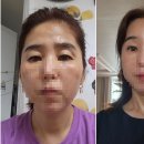 포픽스 이마거상 케이스 신사역 오늘성형외과