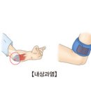 내상과염 (Golf elbow) 이미지