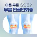 삼성샘물마취통증의학과의원 | 평촌역 마취통증의학과 무릎 연골연화증 치료 운동 방법