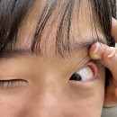 알레르기 | 케토핀프르 점안액, 알레르기 안약 사용 후기