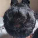 제일의원 | 탈모인의 성지-합덕 제일 의원 4달 후기