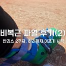 비복근 파열 후기 2탄｜1.5cm 파열 진단, 반깁스 2주차와 허리통증