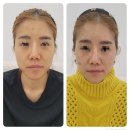 모공 피부 리얼 후기