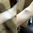 아이러브테니스 | 수유태닝 1위 아이러브탠 – 화이트태닝 3회 체험 후기, 시계 자국 제거