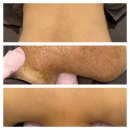 미라클타워 | 청주피부관리 등여드름으로 찾아간 미라클 방문 후기