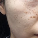 엣지성형외과의원 | [피부관리] 요철과의 전쟁, 대구 편평사마귀 제거 100개 45만원 발품 후기