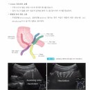 충수염 (Appendicitis) 이미지