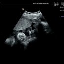 파리바게뜨평안점 | [입원일기3] 33w2d 자궁수축 입원기 4~6일차 퇴원후기 및 라보파 중단 반동수축