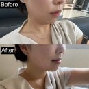 사랑가득의원 | 신사역 지방분해주사 내돈내산 뷰티앤영의원 뷰컷주사 솔직 후기 (전후사진 포함)