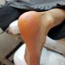 나도손톱 레푸스 개봉점 이미지