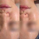 정아 | 창원 중동 정아하다에스테틱 CO2케어 추천후기