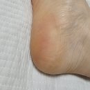 손끝으로 느끼는 손맵씨 | [각질보습엠락틴] 샌들 신기 전 필수! 지저분한 발뒤꿈치 각질 변화와 엠락틴바디로션 사용법