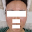 대구 플라즈마 아미뷰티 메디컬스킨케어 후기