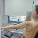 백타일 | 내돈내산 팔뚝 지방흡입 1일차, 2일차 후기