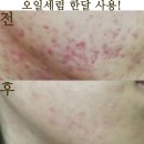 황정숙 피부관리 | 여드름흉터연고 잘지워주네.!