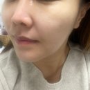 하남피부관리 아라뷰티케어 플라즈마 앰플 관리 후기