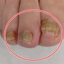 민들레 약국 | 무좀약 연고 추천 (완치후기)