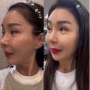 31140-8-50-1 | 강남피부과후기 50대후반 스킨부스터 엑소좀효과 통증 가격