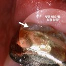 그루터기치과기공소 | 충치 세라믹 인레이, 지르코니아 크라운 및 뿌리만 남은 어금니 임플란트 수술 후기 비용 (의식하진정법)